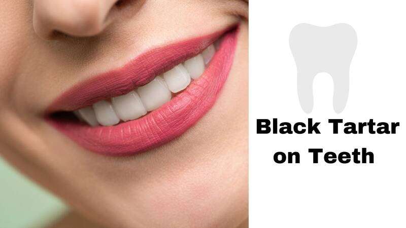Black Tartar on Teeth