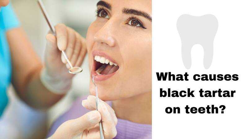 Black Tartar on Teeth