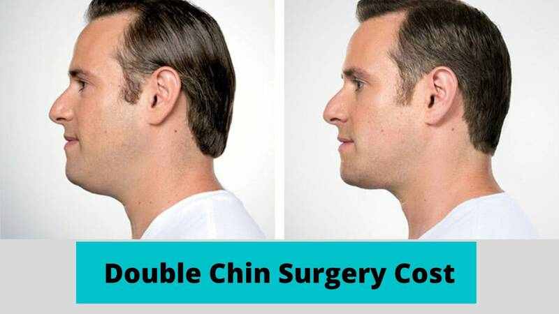 Double Chin Surgery Cost