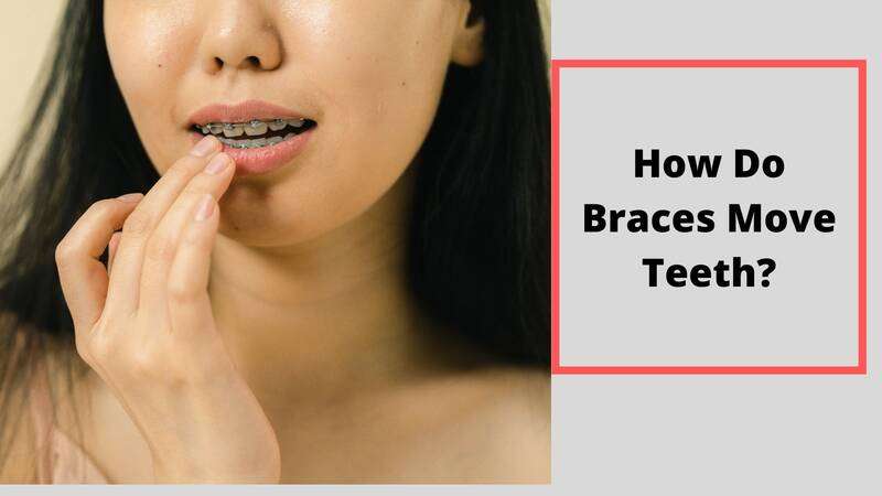 How Do Braces Move Teeth
