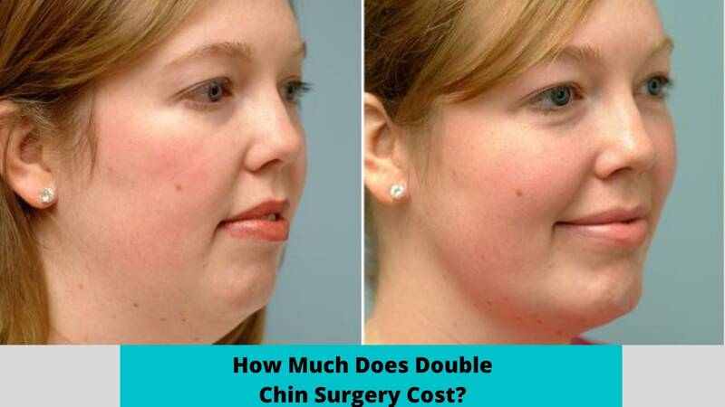 How much does double chin surgery cost