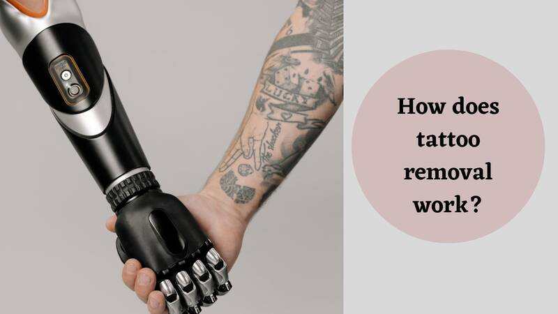 Is Tattoo removal painful