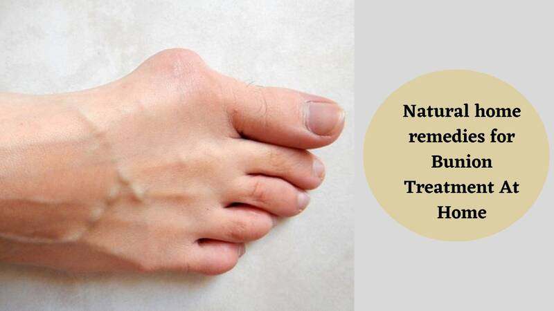 Natural home remedies for Bunion Treatment At Home