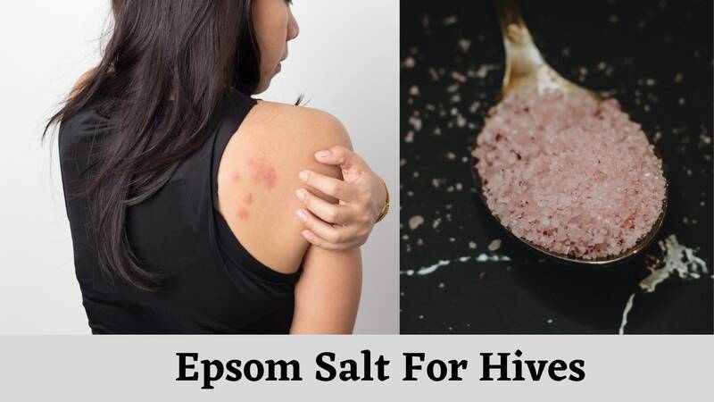 Epsom salt for hives